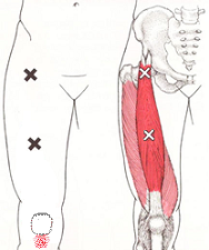 板 円盤 状 半月 膝関節半月板の機能解剖：半月板損傷のメカニズムと症状